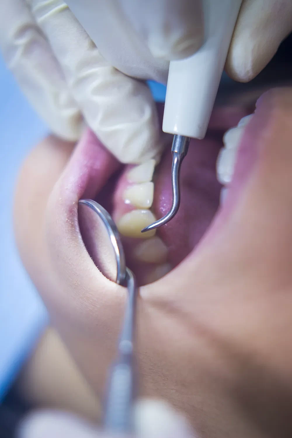 Bone Grafting