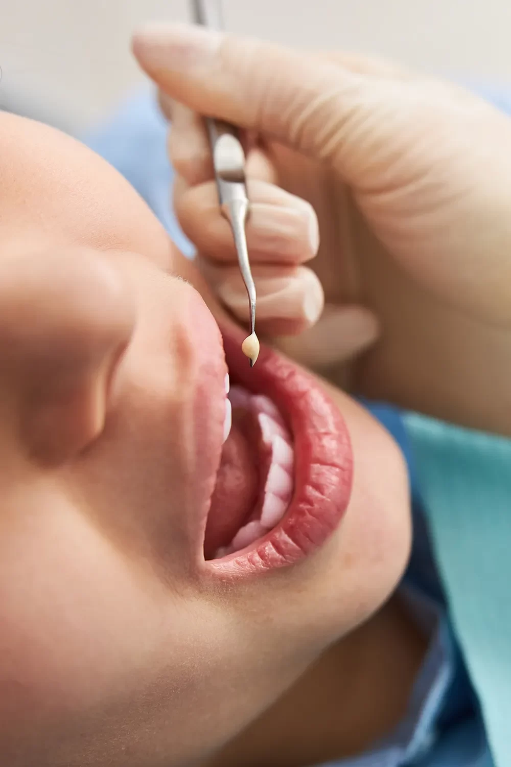Dental Fillings