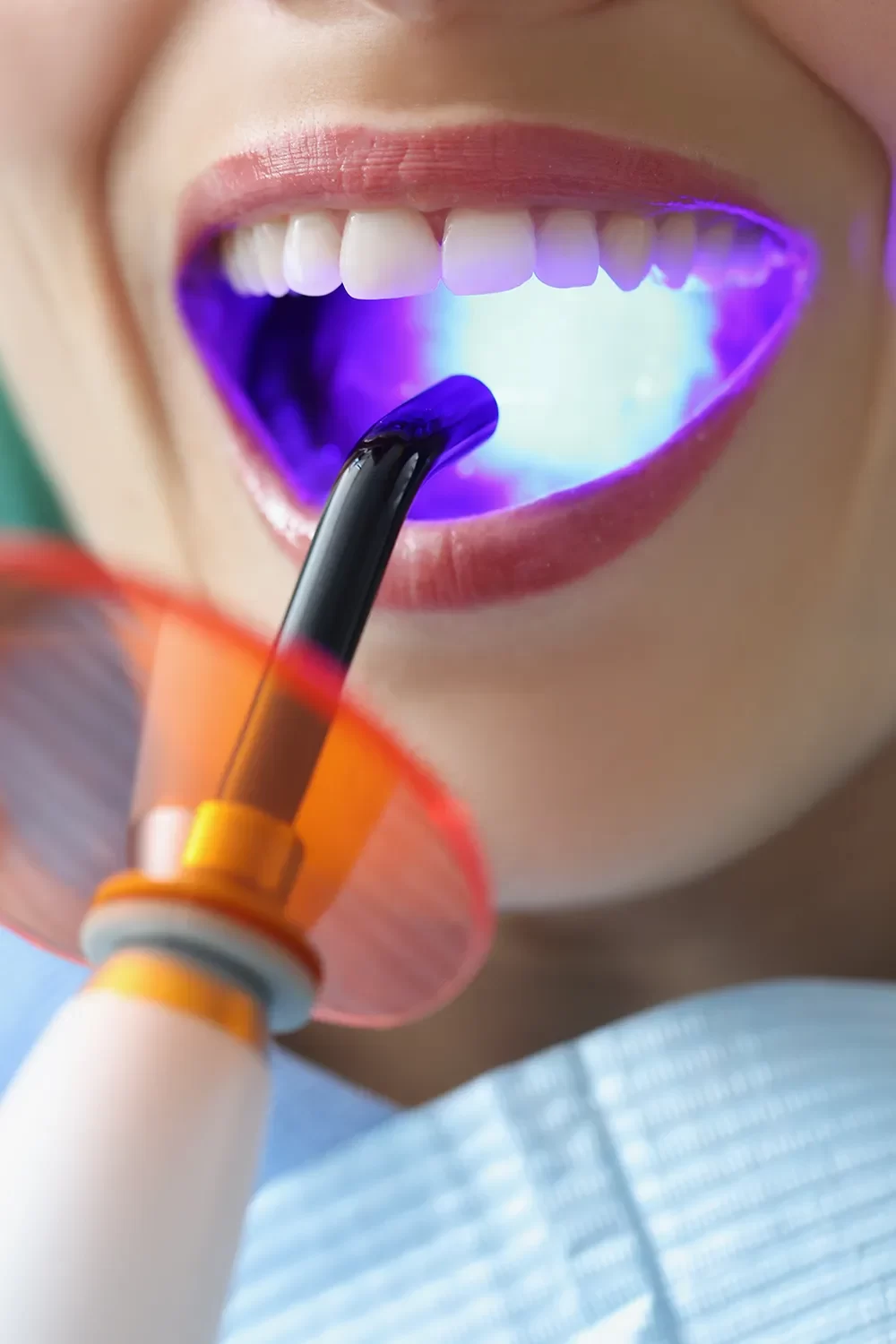 Dental Sealants
